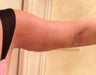 Arm Lift
