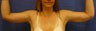 Brachioplasty