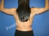 Arm Lift