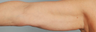 Brachioplasty