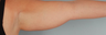 Brachioplasty/Liposuction