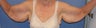 Brachioplasty