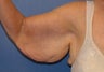 Brachioplasty