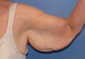 Brachioplasty