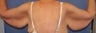Brachioplasty