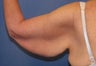 Brachioplasty