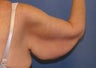 Brachioplasty