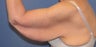 Brachioplasty