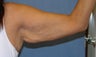 Brachioplasty