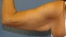 Brachioplasty