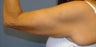 Brachioplasty