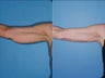 Brachioplasty - Upper Arm Lift