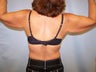Arm Lift Surgery