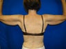 Arm Lift Surgery