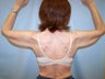 Arm Lift Surgery
