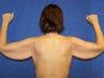 Arm Lift Surgery