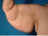 Arm Lift