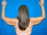 Arm Lift Surgery (Brachioplasty)