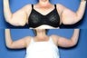 Arm Lift