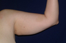Arm Lift