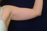 Arm Lift