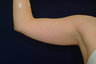 Arm Lift