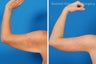 Arm Lift aka Brachioplasty