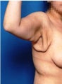 Brachioplasty