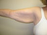 Brachioplasty