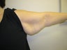 Brachioplasty
