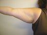 Arm Lift