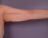 Arm Lift