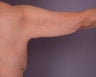 Arm Lift