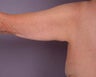 Arm Lift