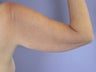 Arm Lift