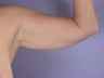 Arm Lift