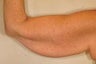Brachioplasty (Arm Lift)