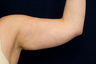 Liposuction - Upper Arms