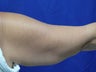Arm Lift