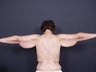 42 year old with sagging arm skin