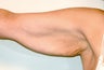 Brachioplasty (Arm Lift) After Massive Weight Loss (Front View)