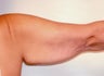 Brachioplasty (Arm Lift) After Massive Weight Loss (Posterior View)