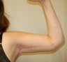 Brachioplasty
