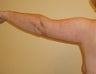 Arm Lift