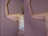 Arm Lift