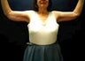 Arm Lift