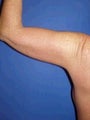 Arm Lift