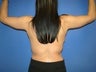 Arm Lift