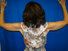 Arm Lift