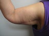 Arm Lift